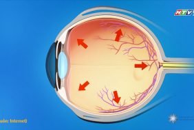 BỆNH GLAUCOMA