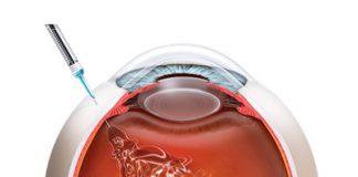 Tiêm chất kháng VEGF vào nội nhãn điều trị AMD thể ướt