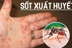 BỆNH SỐT XUẤT HUYẾT: 6 DẤU HIỆU VÀ CÁCH THEO DÕI CHĂM SÓC TẠI NHÀ